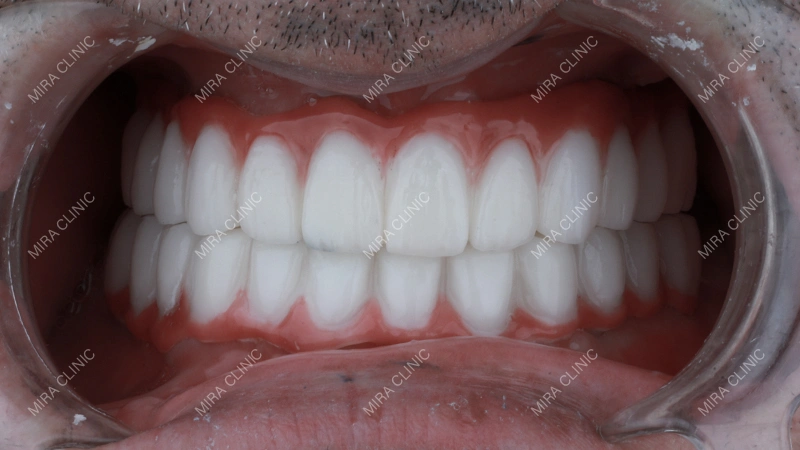 Full-Arch Treatments